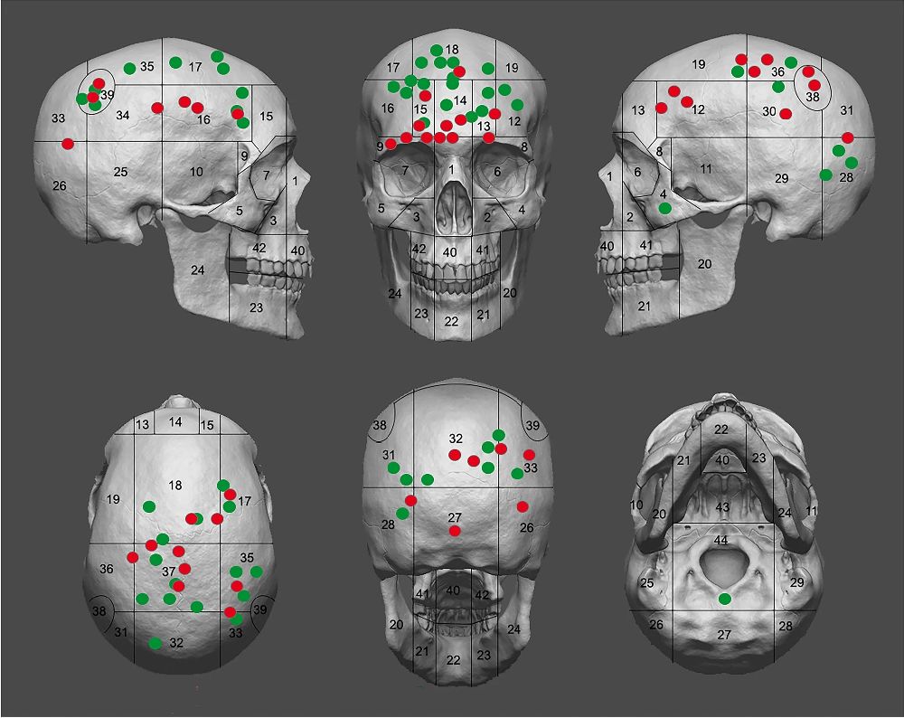 Ein Schema mit einem Schädel, der von mehreren Seiten gezeigt wird. Er ist gerade an der Stirn überseht, mit Grünen und roten Punkten. Aber aus am Hinterkopf und an den Augenbrauen.